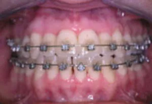 Behandlung mit Brackets